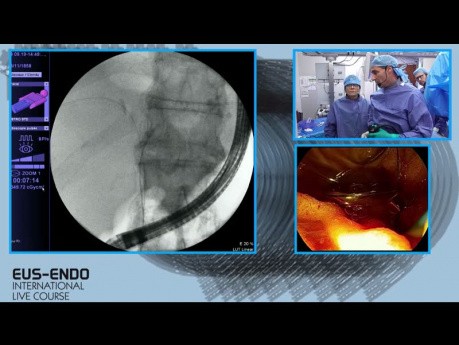 L'ablation par radiofréquence (RFA) et prothèse biliaire par voie endoscopique