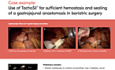 Utilisation de TachoSil® en Chirurgie Bariatrique pour une Hémostase et une Etanchéité Suffisantes lors de la Procédure de Pontage Gastrique Roux-en-Y