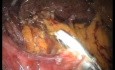 Réparation Laparo-Endoscopique d'une Hernie de Morgagni (LESS) et Fundoplicature de Toupet