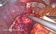 Fundoplicature de Nissen Laparoscopique 