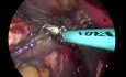 Hystérectomie vNOTES pour Hyperplasie Endométriale
