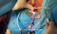 Incontinence Urinaire d'Effort - Cervicosuspension TOT
