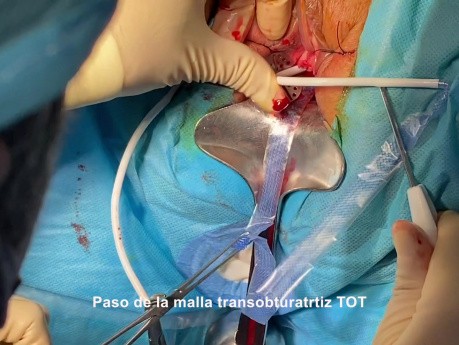Incontinence Urinaire d'Effort - Cervicosuspension TOT