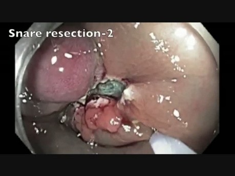 Côlon: Résection Muqueuse Endoscopique compliquée d'une perforation - partie 5