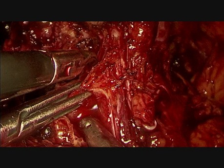 Prostatectomie radicale laparoscopique