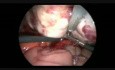 Salpingo-ovariectomie laparoscopique en raison d'un gros kyste dermoïde et des adhérences sévères