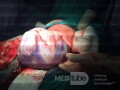 Une grossesse gémellaire, l'accouchement sous césarienne 1