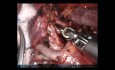 Tri-segmentectomie pulmonaire du lobe supérieur gauche par voie thoracoscopique robot-assistée