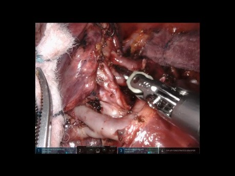 Tri-segmentectomie pulmonaire du lobe supérieur gauche par voie thoracoscopique robot-assistée