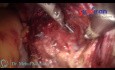 Hystérectomie Totale Coelioscopique chez une Patiente aux Antécédants de Césariennes Multiples