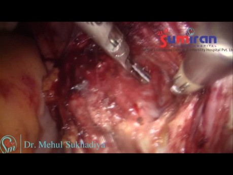 Hystérectomie Totale Coelioscopique chez une Patiente aux Antécédants de Césariennes Multiples