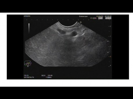 Tumeur neuroendocrine pancréatique, écho-endoscopie