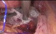 Suspension de l'utérus par voie laparoscopique