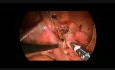 Exérèse Cœlioscopique d'un Kyste de l'Ouraque chez l'Enfant