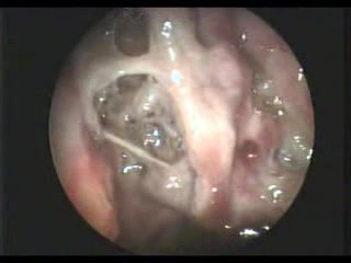 Asticots dans le nez chez un patient atteint de rhinite atrophique