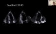 Échocardiographie en Cardio-Oncologie