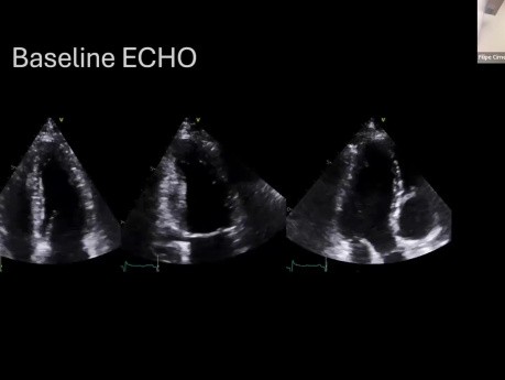Échocardiographie en Cardio-Oncologie