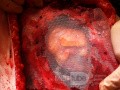 Défaut tissulaire dans la paroi thoracique recouvert d'un filet de polypropylène, le péricarde reste intact après l'exérèse du liposarcome du sein gauche