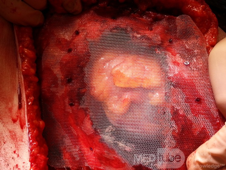 Défaut tissulaire dans la paroi thoracique recouvert d'un filet de polypropylène, le péricarde reste intact après l'exérèse du liposarcome du sein gauche