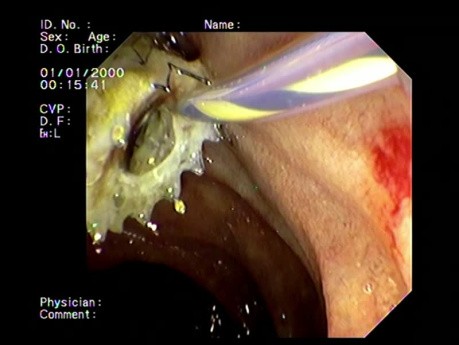 Self-Expanding Metal Stents (SEMS) 
