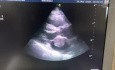 Myxome Atrial Gauche