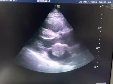 Myxome Atrial Gauche