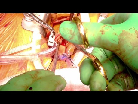 Remplacement de la valve aortique par thoracotomie antérieure droite. Prothèse Avalus.