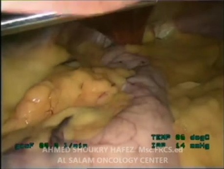 Gastrectomie longitudinale par laparoscopie pour une obésité morbide