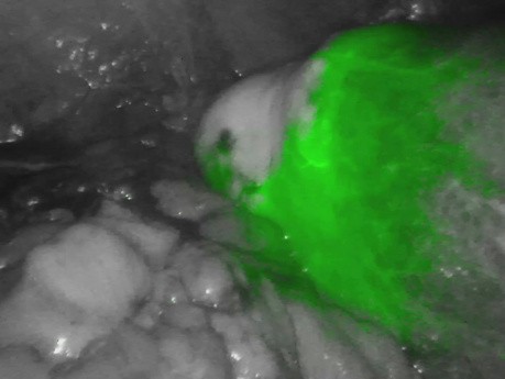 Anastomose après Hémicolectomie Droite: Test de Perfusion ICG (Vert d'Indocyanine)