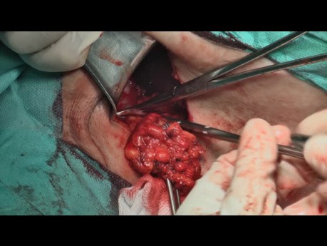La dissection des ganglions axillaires chez une patiente atteinte d'un cancer du sein.