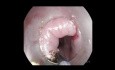 Diverticulotomie de la Déhiscence de Killian (Myotomie)