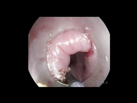 Diverticulotomie de la Déhiscence de Killian (Myotomie)