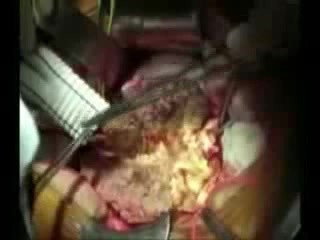 Anévrisme de l'aorte abdominale