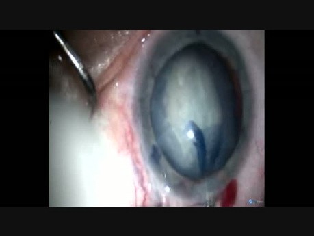 Rôle du rhéxis ovale dans la cataracte subluxée