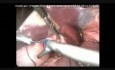 Traitement d'ulcère gastroduodénal perforé par voie laparoscopique