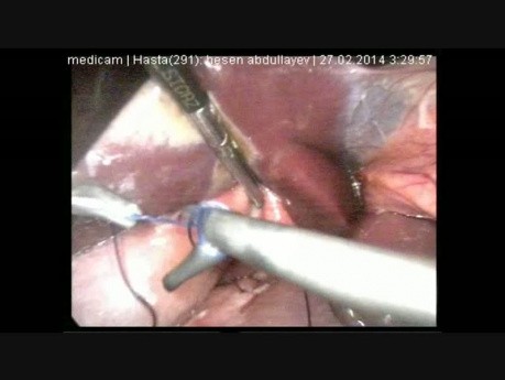 Traitement d'ulcère gastroduodénal perforé par voie laparoscopique