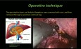 Traitement laparoscopique d'un gros kyste hydatique du foie central (avec dessins)