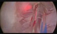 Enucléation de la prostate par laser Greenlight