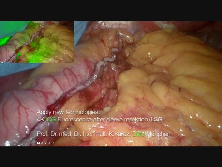 Gastrectomie en manchon en utilisant le vert d'indocyanine (ICG) pour visualiser des vaisseaux sanguins de l'angle de His