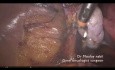 Hystérectomie pour cancer de l'endomètre - film didactique