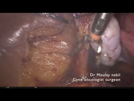 Hystérectomie pour cancer de l'endomètre - film didactique