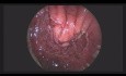 Nouvelle Méthode pour le Traitement des Fistules Rectovésicales: Plastie du Muscle Rectal par MET (Microchirurgie Endoscopique Transanale)