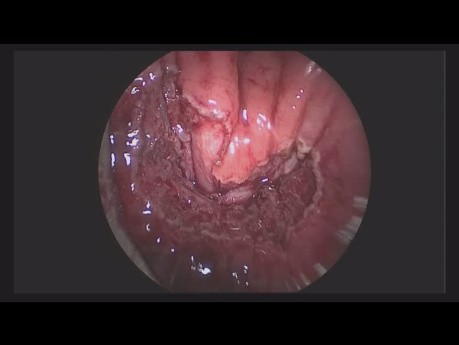 Nouvelle Méthode pour le Traitement des Fistules Rectovésicales: Plastie du Muscle Rectal par MET (Microchirurgie Endoscopique Transanale)