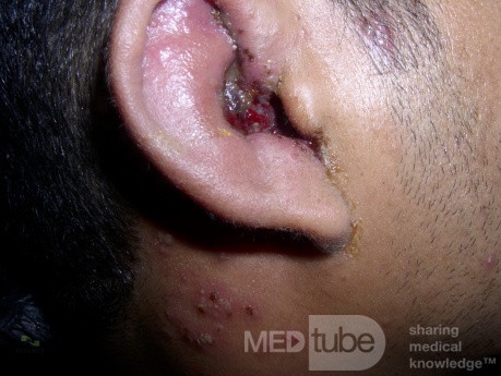 Le syndrome de Ramsay-Hunt - Le zona auriculaire , herpes zoster oticus 