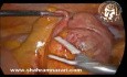 Hémicolectomie droite laparoscopique pour un adénocarcinome mucineux appendiculaire diagnostiqué après une appendicectomie de routine