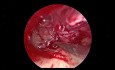 Tympanoplastie Endoscopique de Révision pour Surdité de Transmission