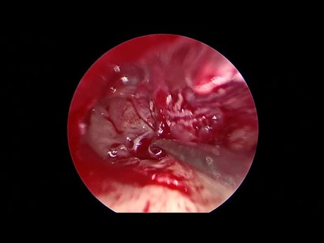 Tympanoplastie Endoscopique de Révision pour Surdité de Transmission