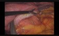 Une fuite lymphatique du ligament splénogastrique