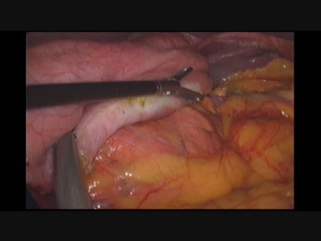 Une fuite lymphatique du ligament splénogastrique