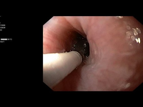 Dilatation endoscopique au ballonnet CRE pour sténose caustique de l'oesophage